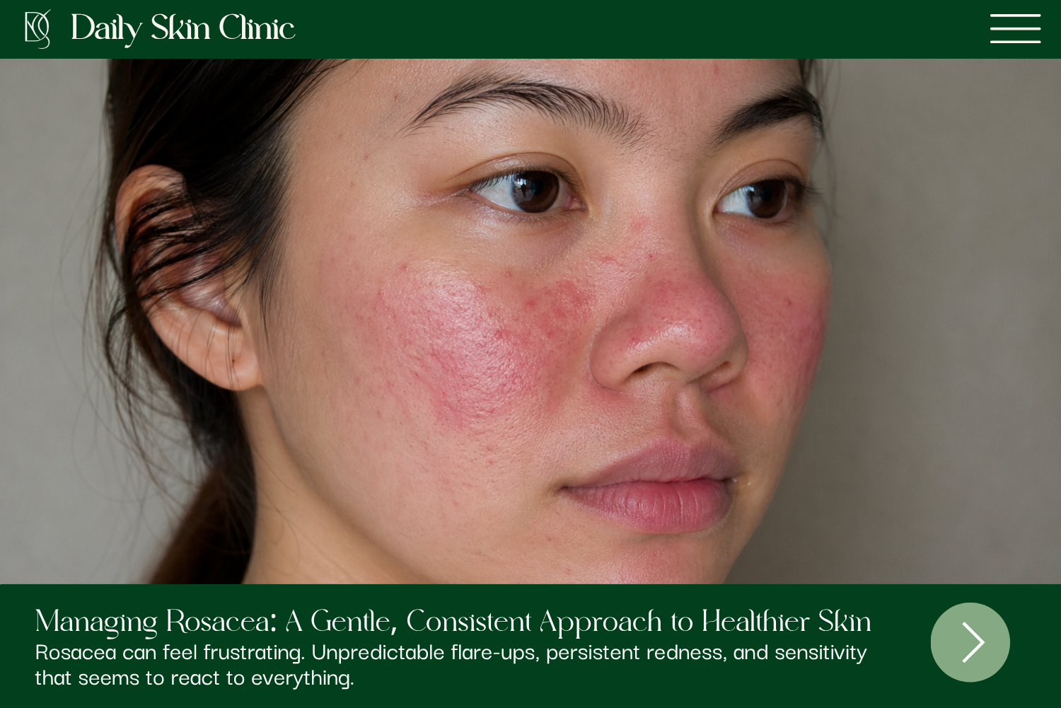 Managing Rosacea: A Gentle, Consistent Approach to Healthier Skin