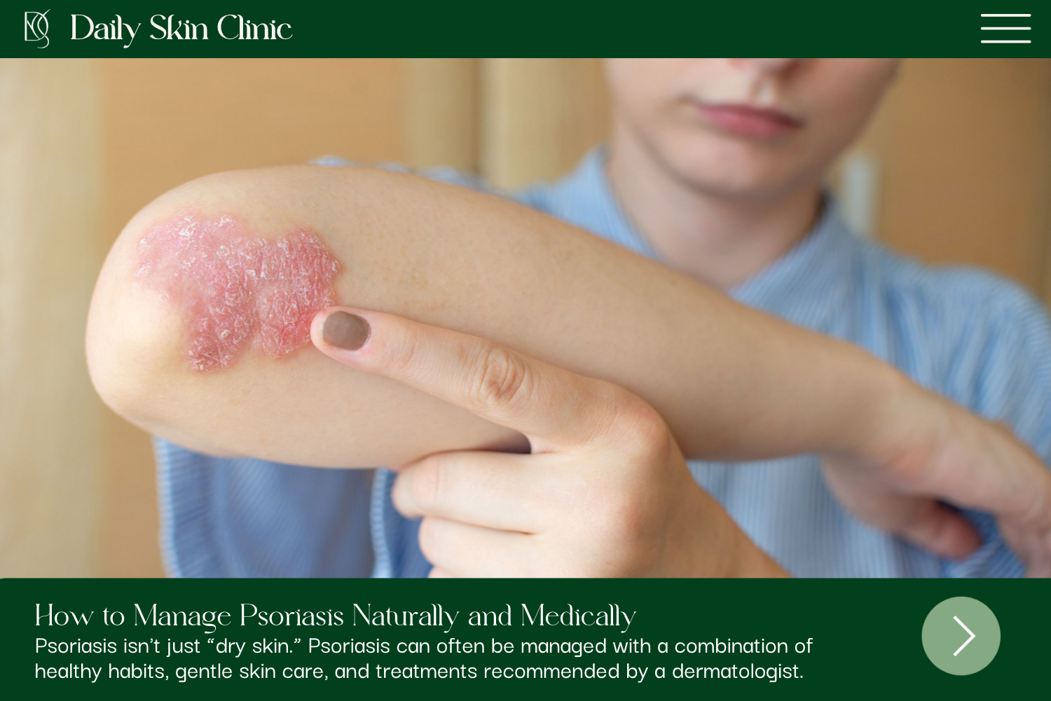 How to Manage Psoriasis Naturally and Medically